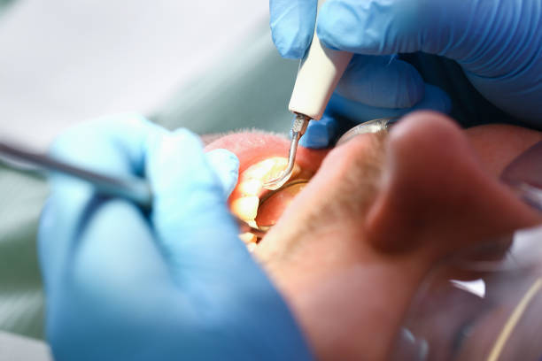 Best Emergency Treatment for Dental Infections or Abscesses in Billings, MT